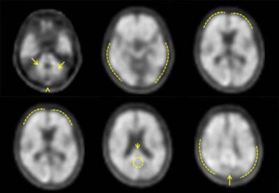 Home Neuraceq Florbetaben F Injection Life Molecular Imaging