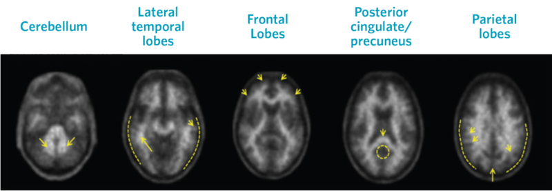 Negative Neuraceq Scan