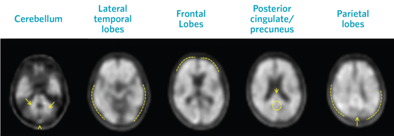 Positive Neuraceq Scan