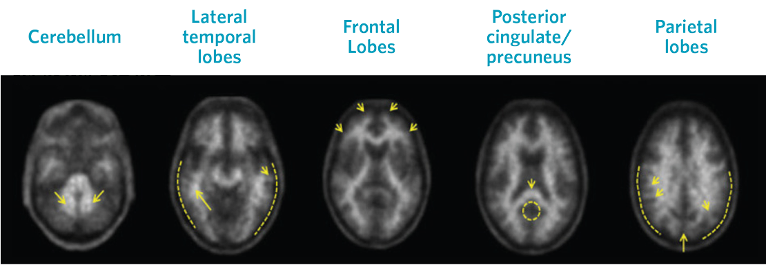 Negative Neuraceq Scan