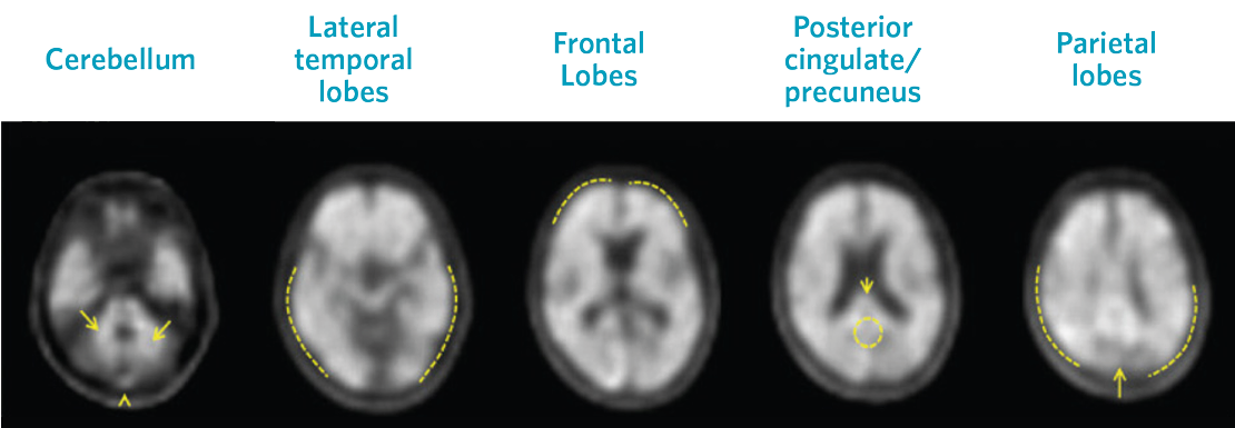 Positive Neuraceq Scan