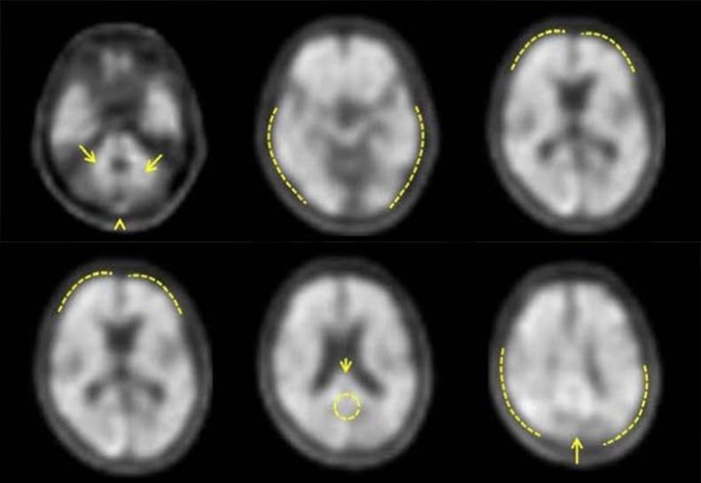 Neuraceq Reader Training